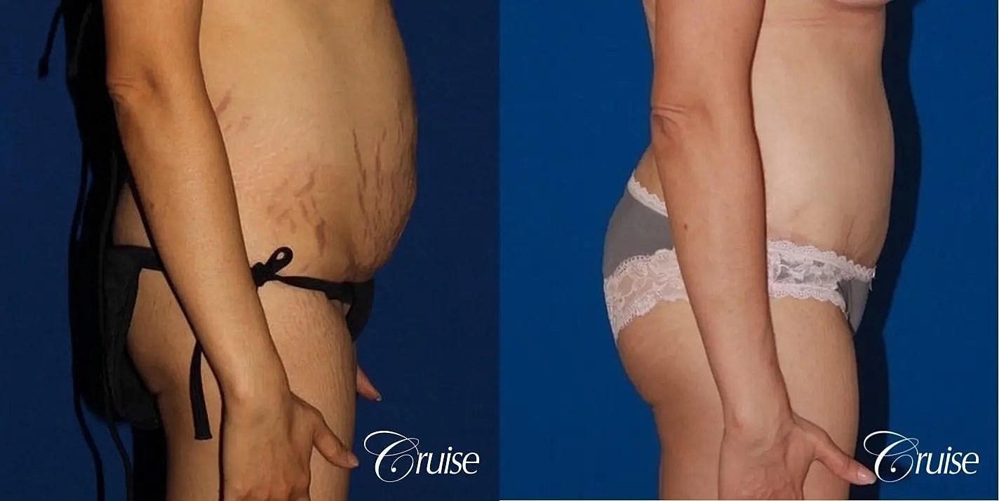 Tummy Tuck Before & After