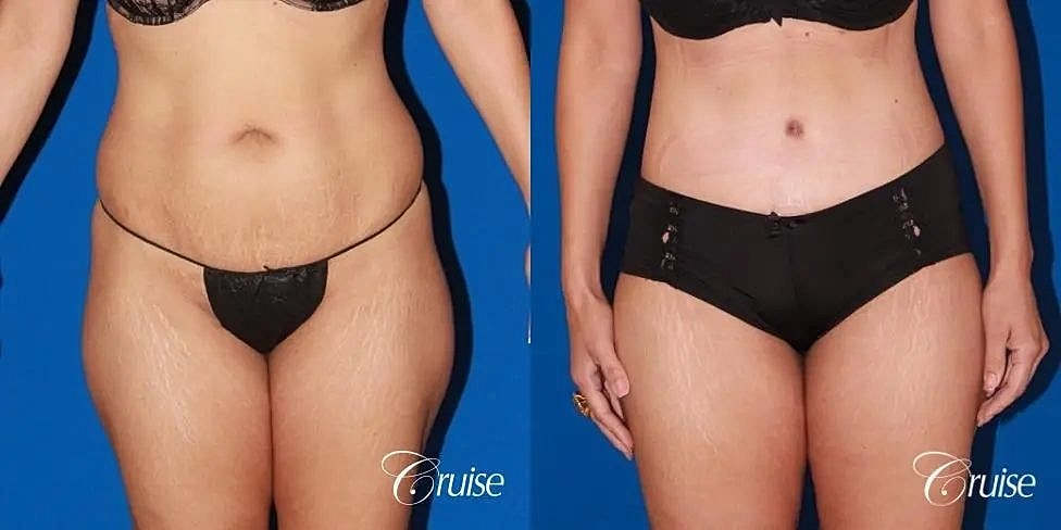 Tummy Tuck Before & After