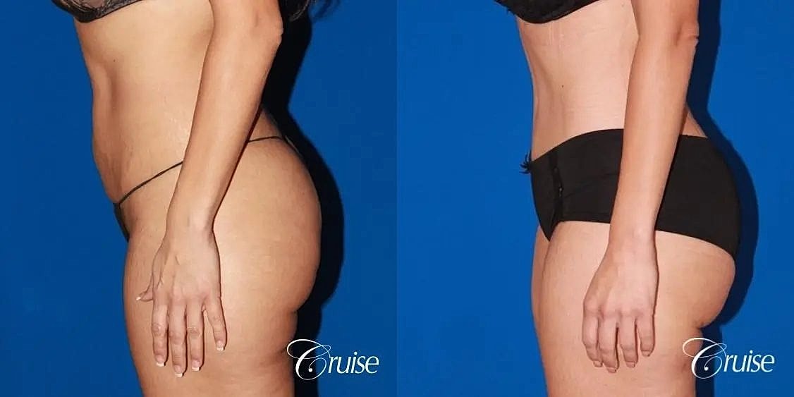 Tummy Tuck Before & After