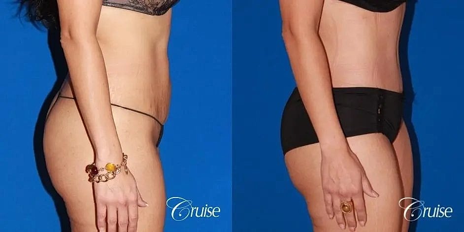 Tummy Tuck Before & After