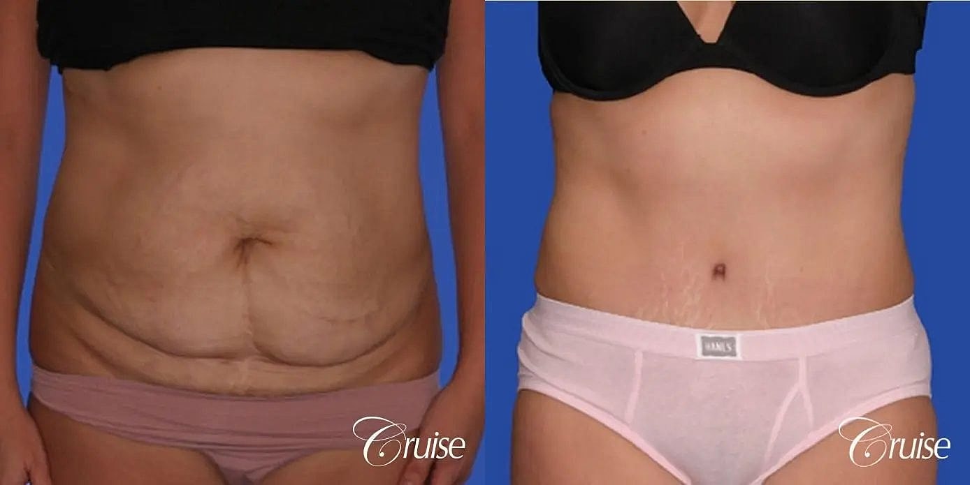 Tummy Tuck Before & After