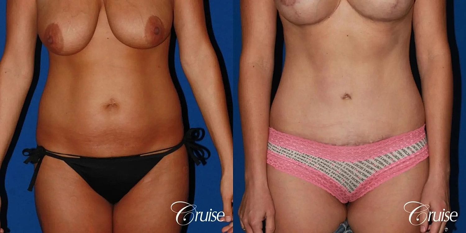 Tummy Tuck Before & After