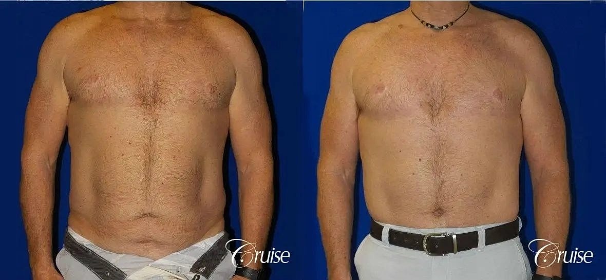 Tummy Tuck Before & After