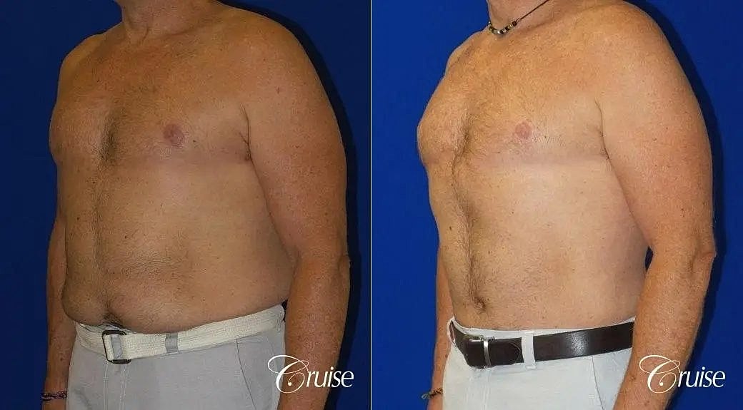 Tummy Tuck Before & After
