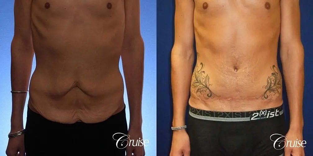 Tummy Tuck Before & After