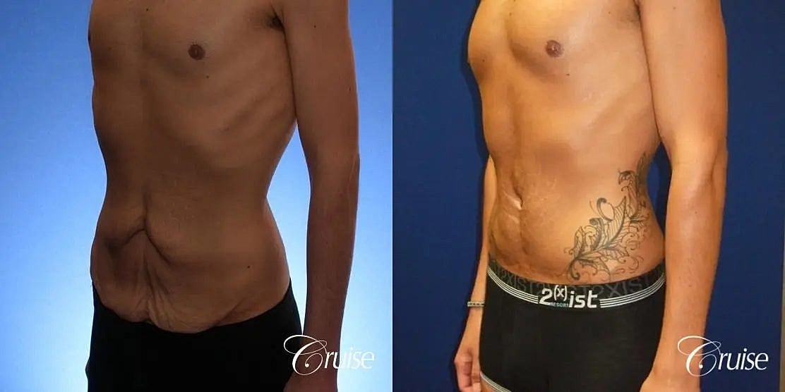 Tummy Tuck Before & After