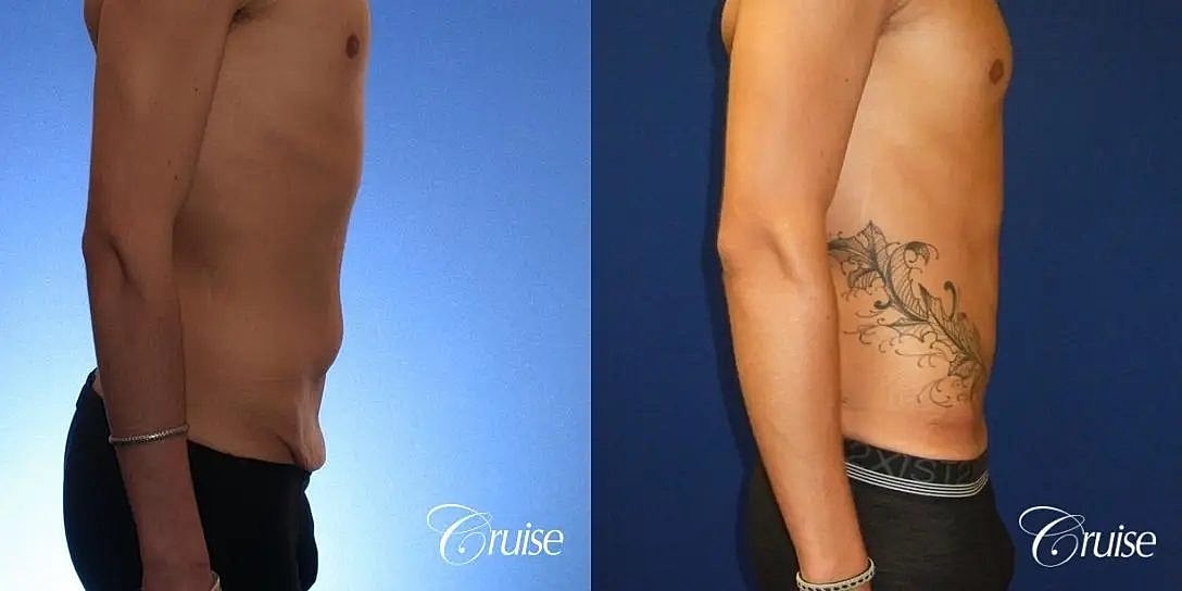 Tummy Tuck Before & After