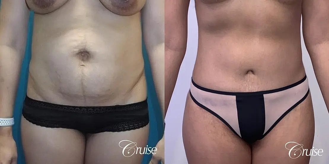 Tummy Tuck Before & After