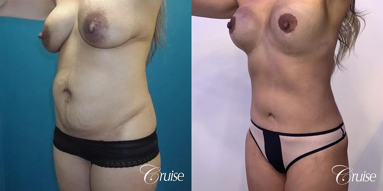 Tummy Tuck Before & After