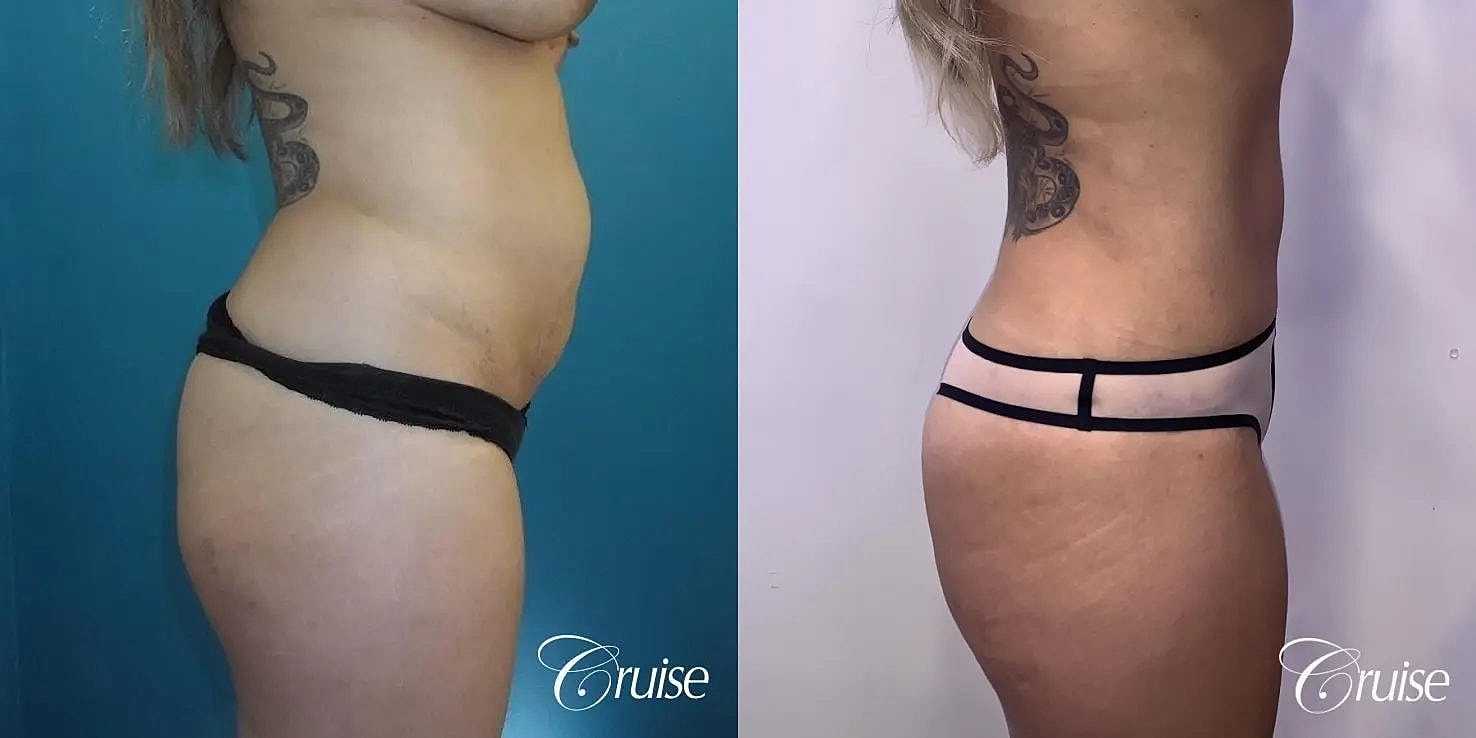 Tummy Tuck Before & After