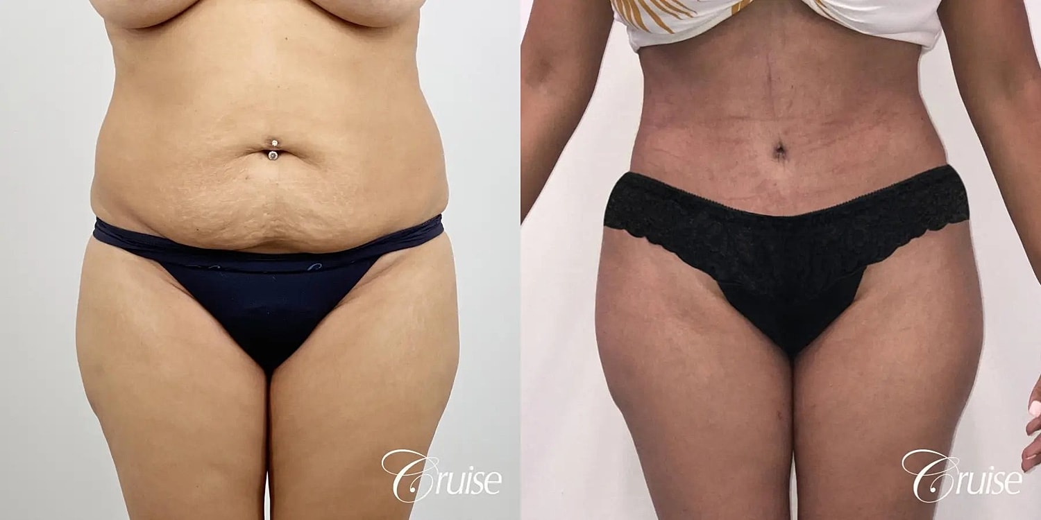 Tummy Tuck Before & After
