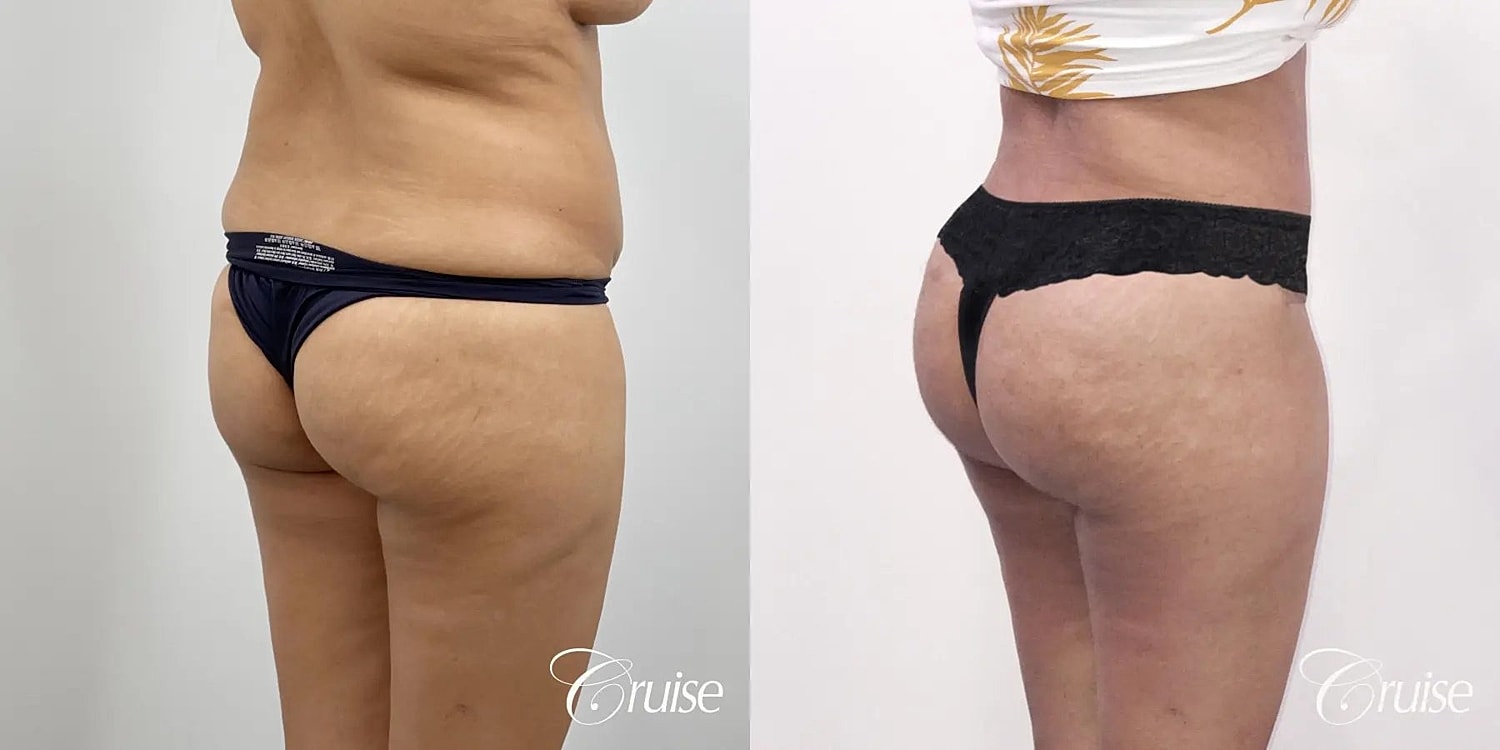 Tummy Tuck Before & After