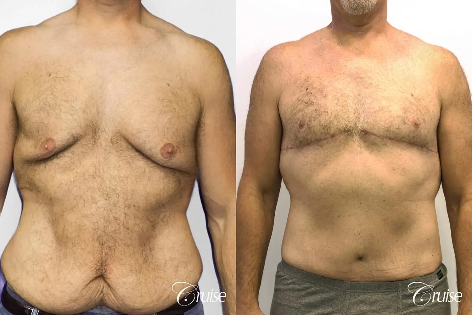 Tummy Tuck Before & After