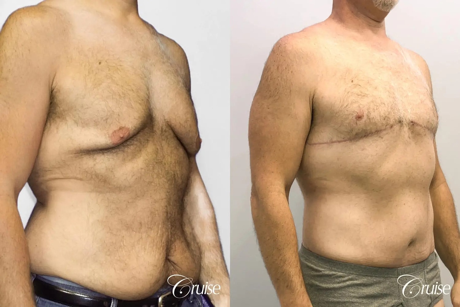 Tummy Tuck Before & After