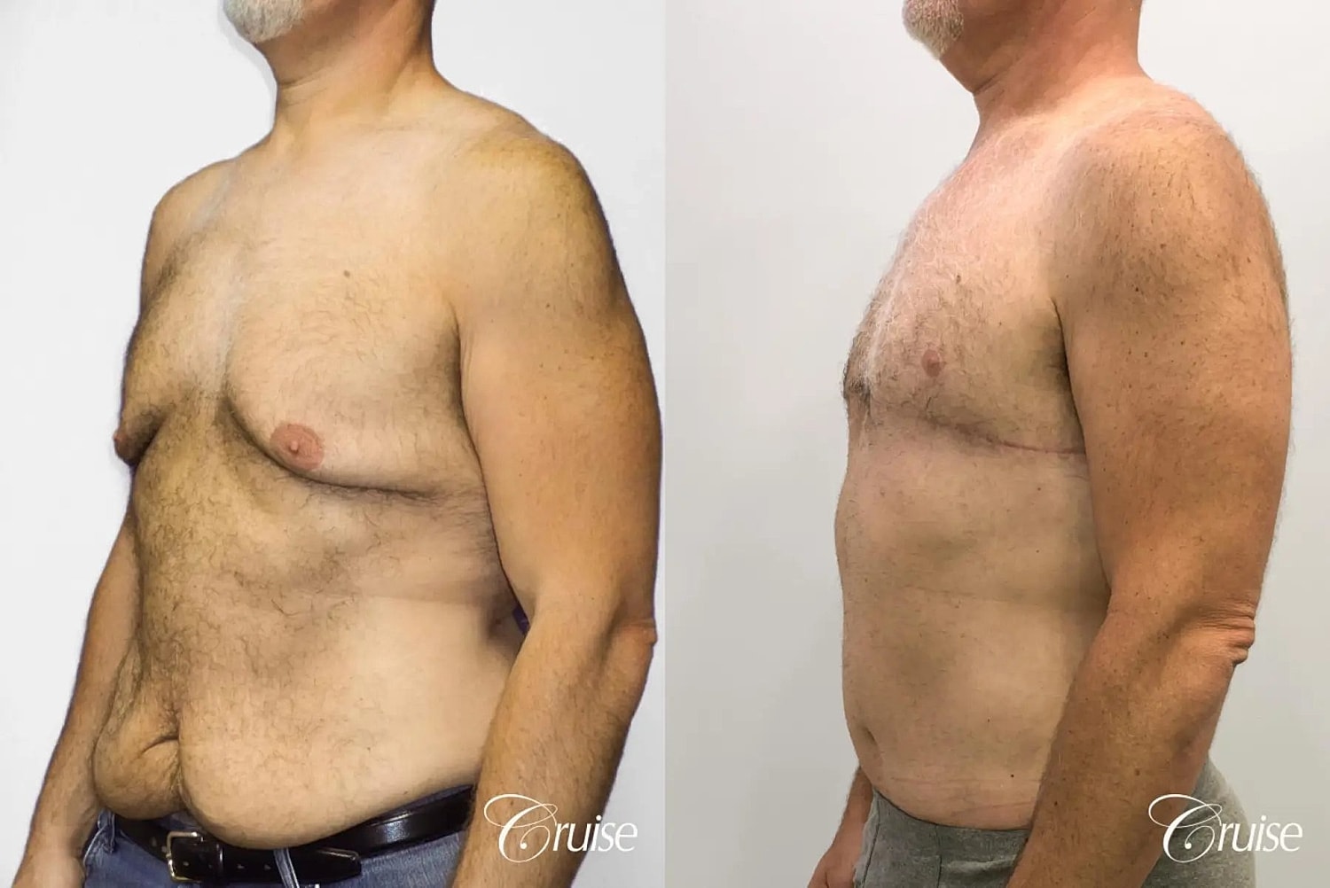 Tummy Tuck Before & After