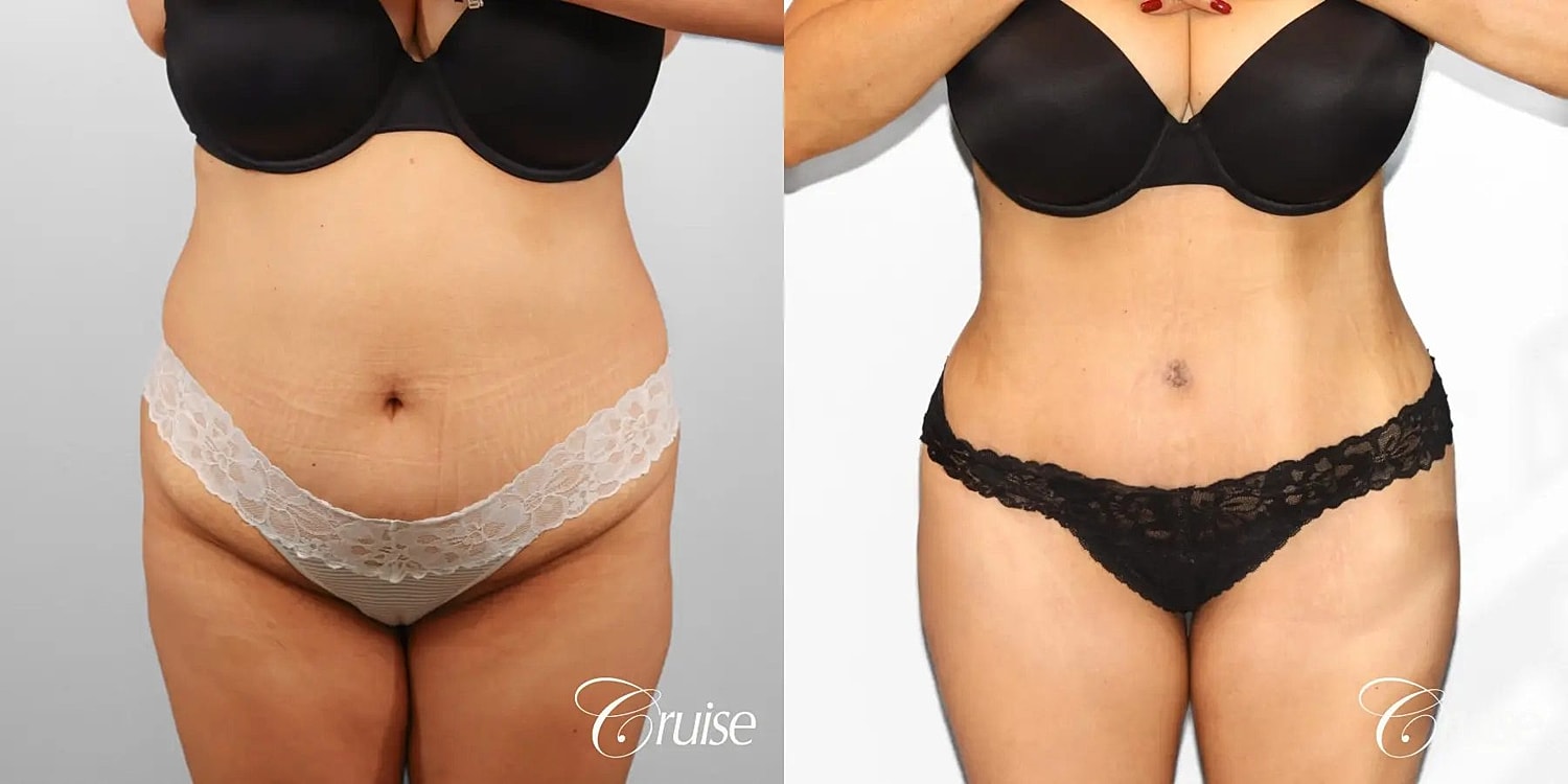 Tummy Tuck Before & After