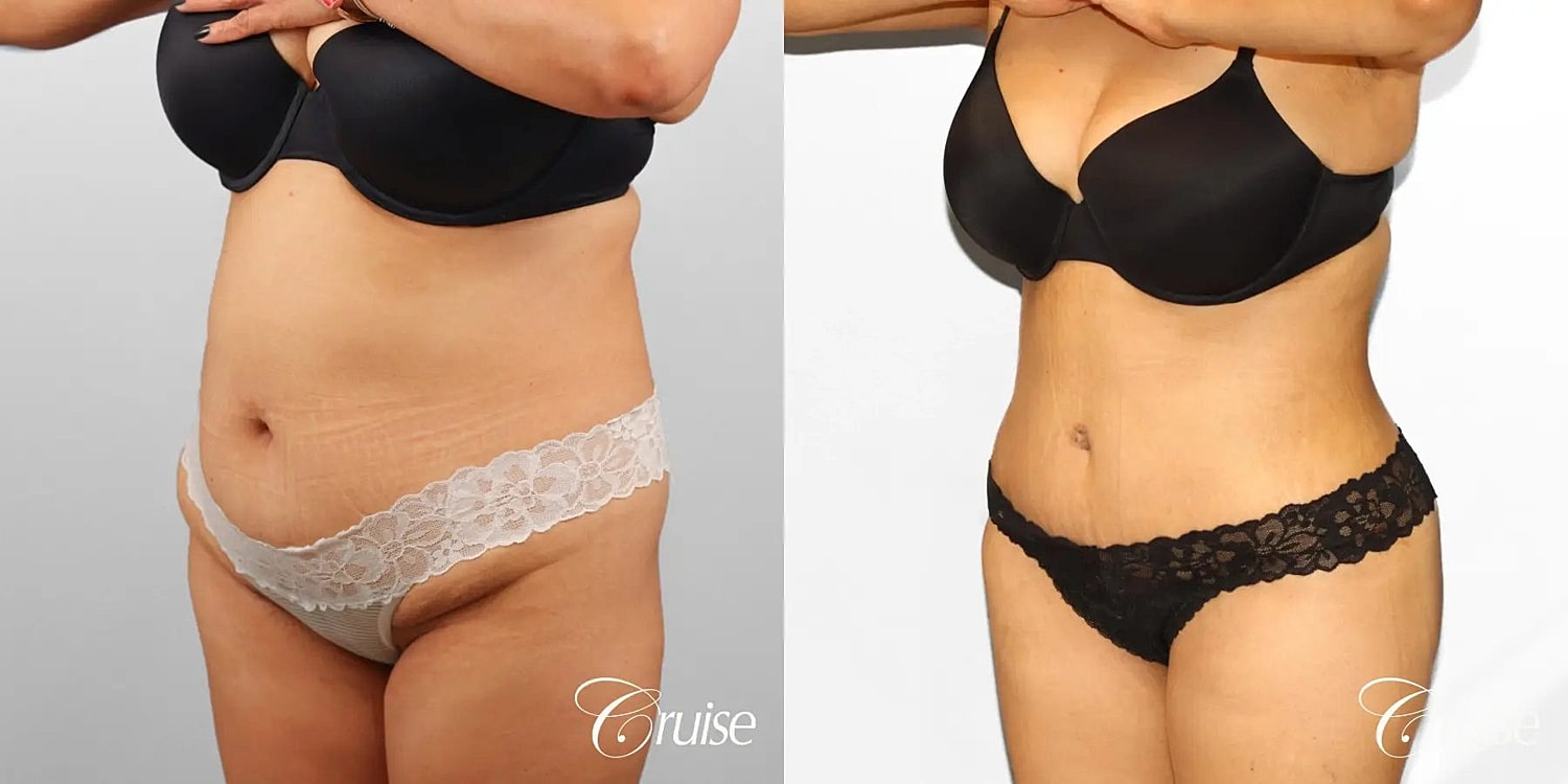 Tummy Tuck Before & After