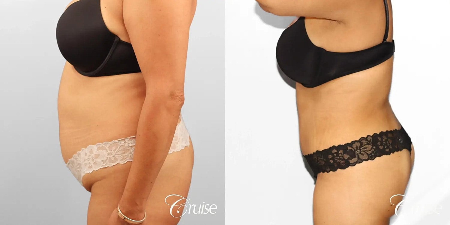 Tummy Tuck Before & After