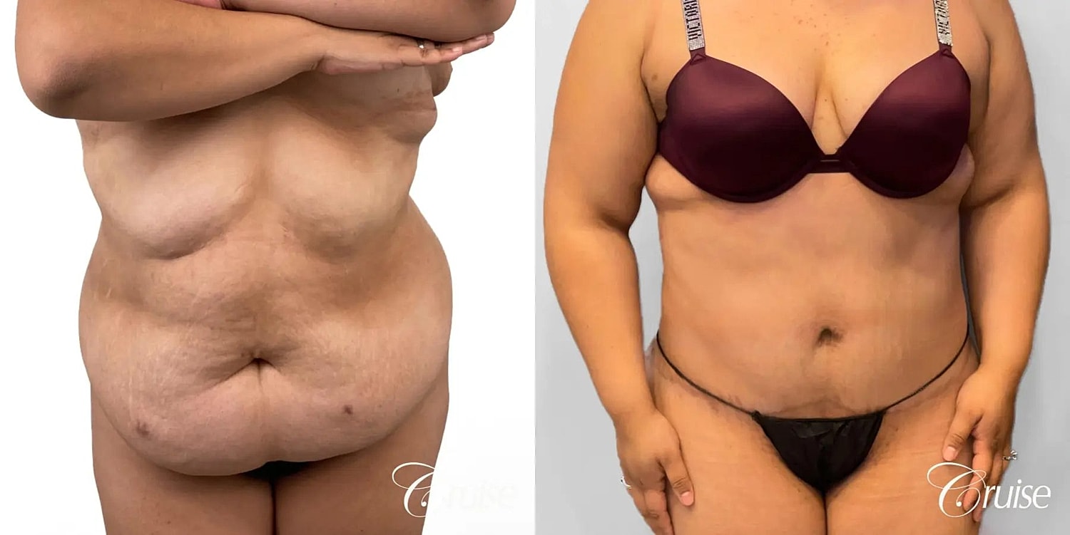 Tummy Tuck Before & After