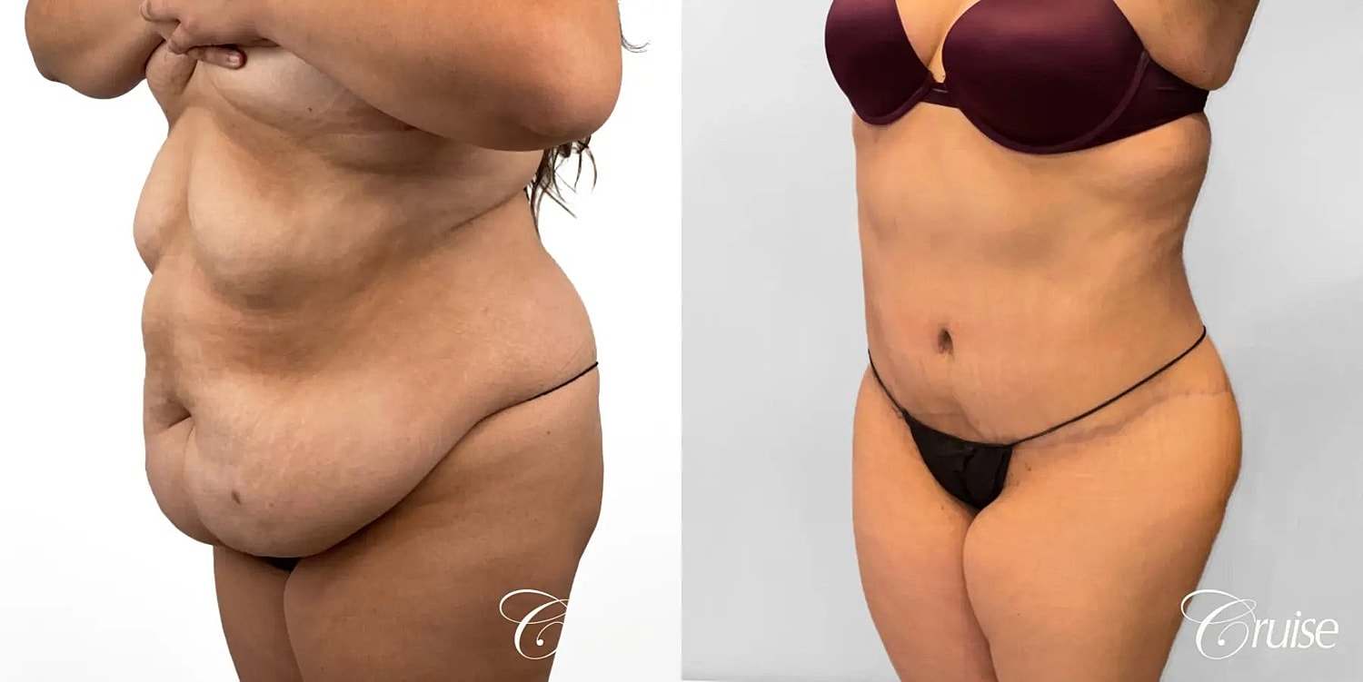Tummy Tuck Before & After