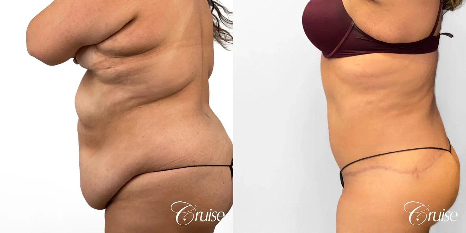 Tummy Tuck Before & After