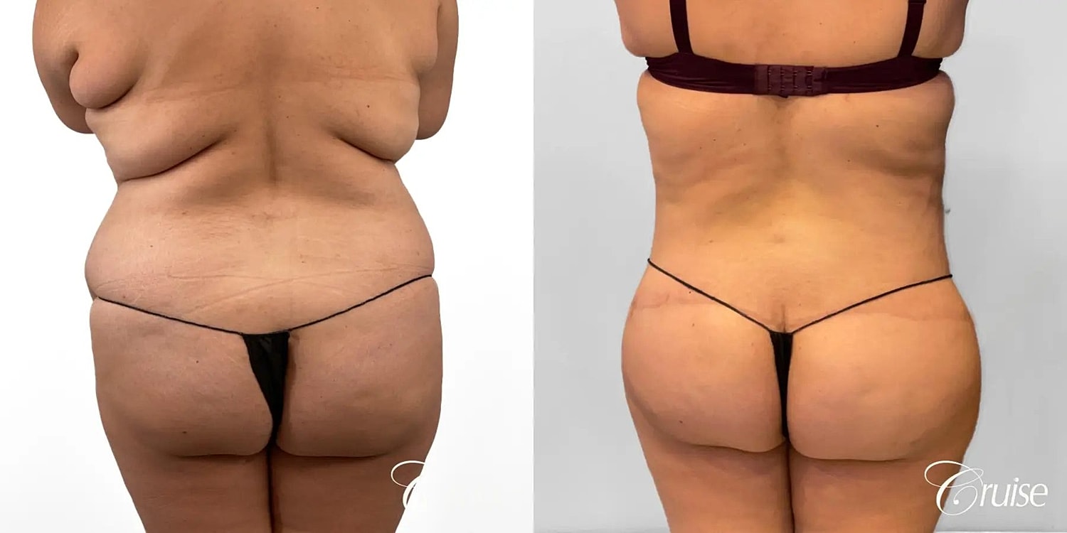 Tummy Tuck Before & After