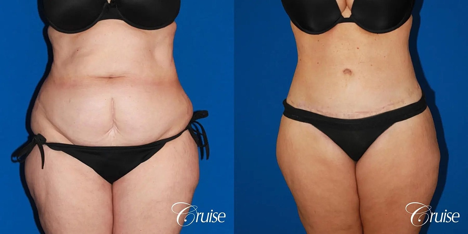 Tummy Tuck Before & After