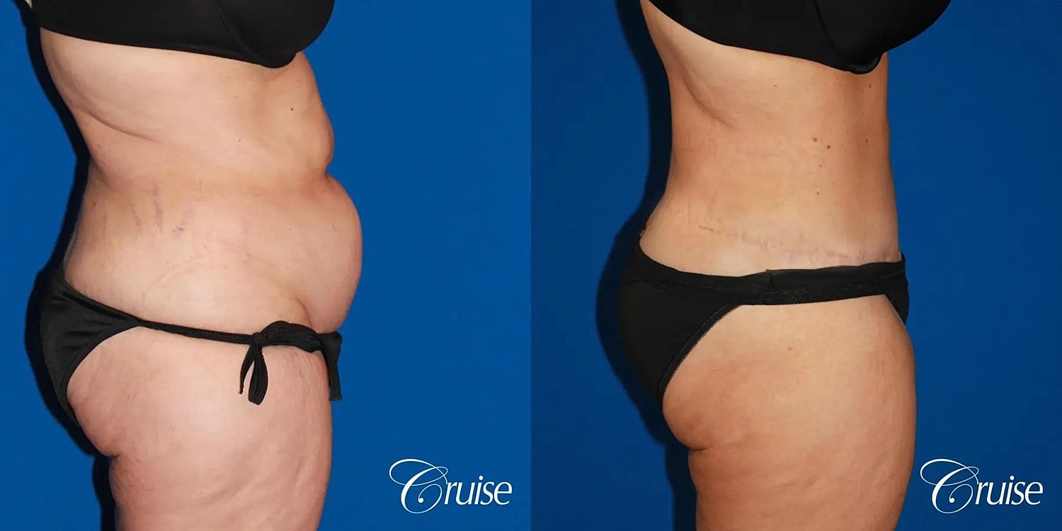 Tummy Tuck Before & After
