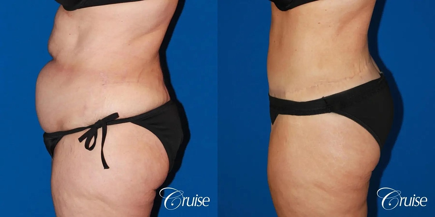 Tummy Tuck Before & After