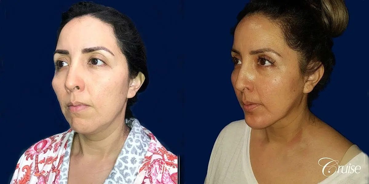 Liposuction Before & After