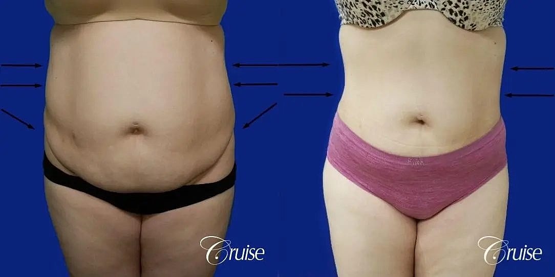 Liposuction Before & After