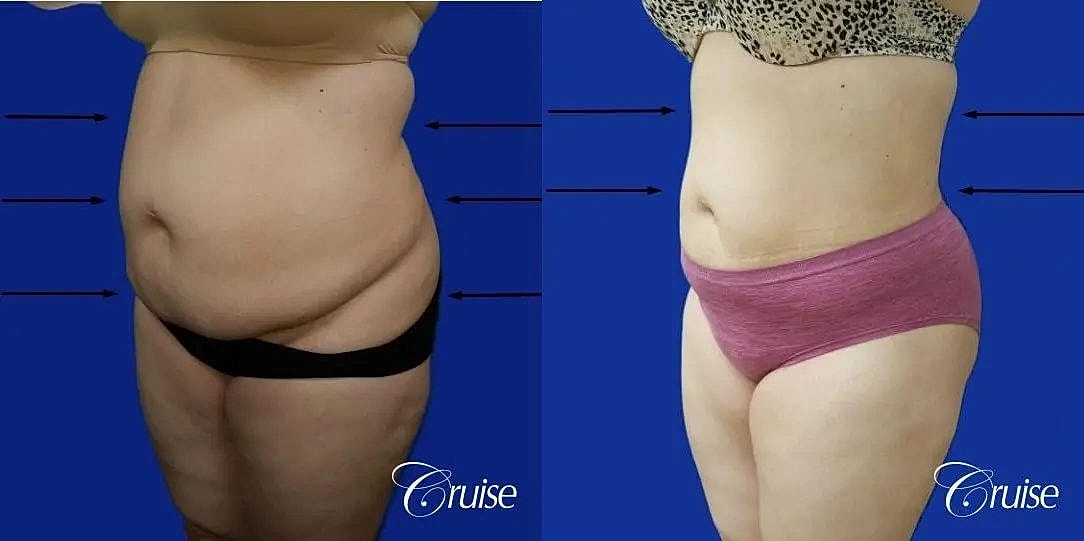 Liposuction Before & After