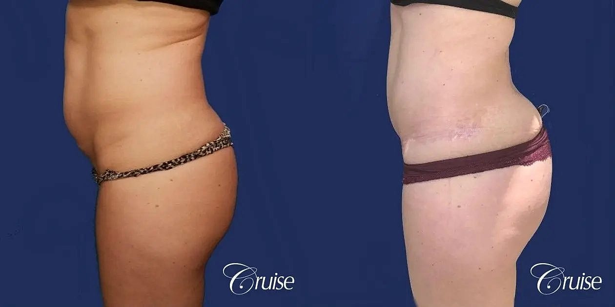 Liposuction Before & After