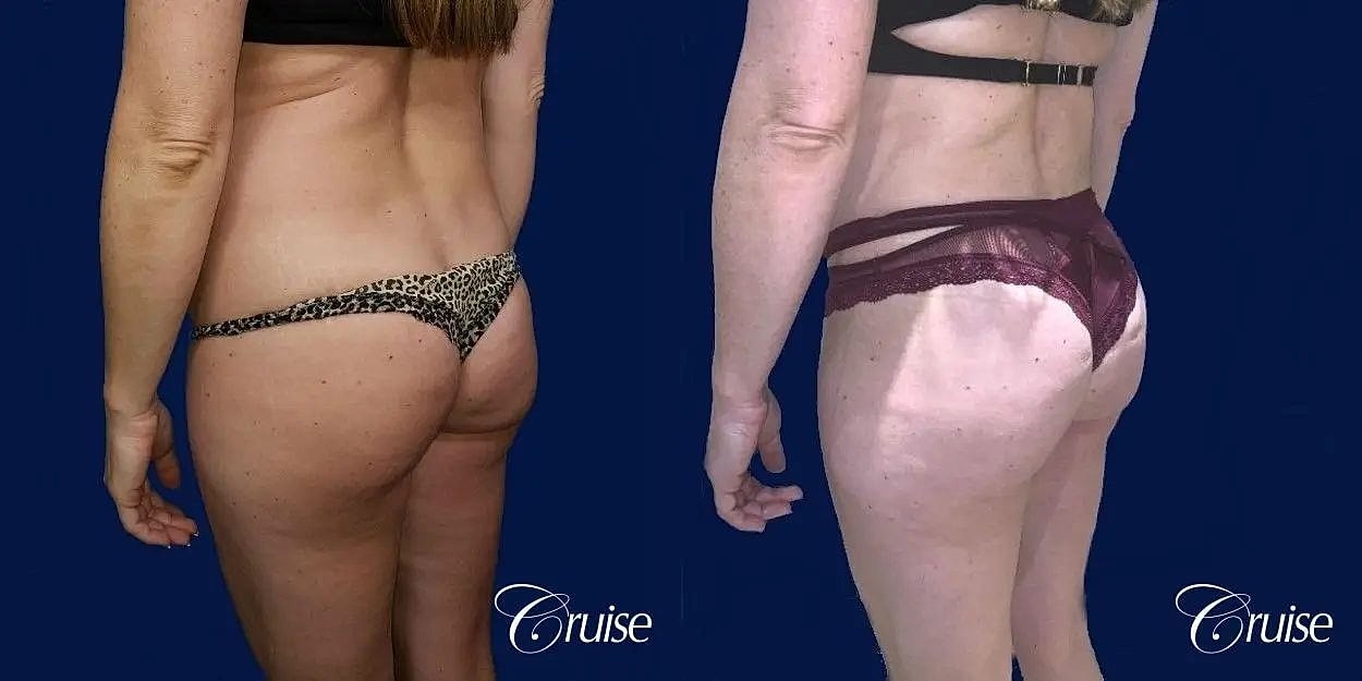 Liposuction Before & After