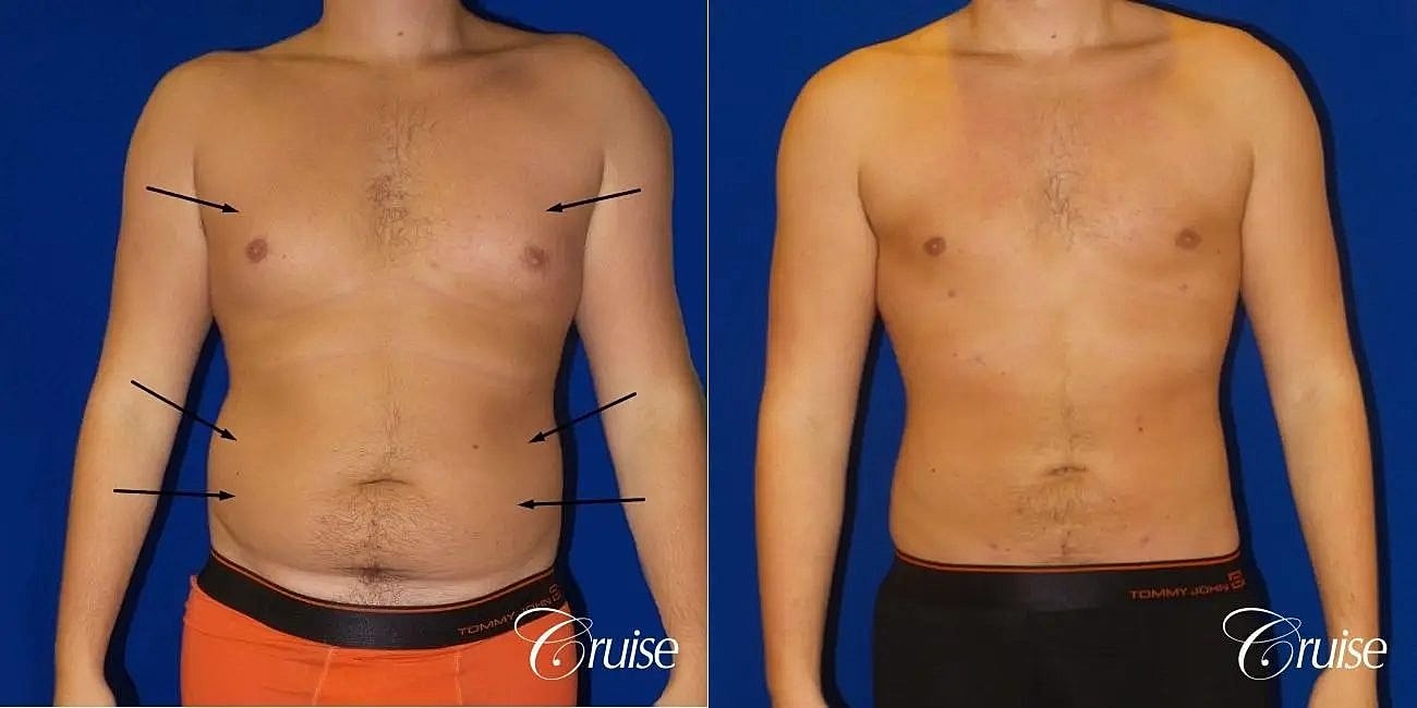 Liposuction Before & After