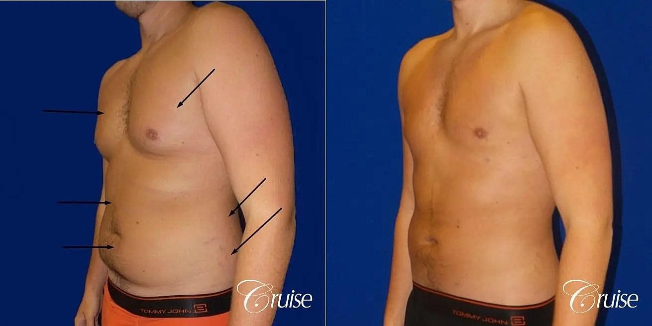Liposuction Before & After