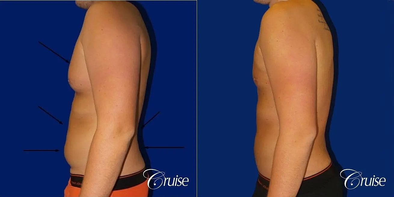 Liposuction Before & After