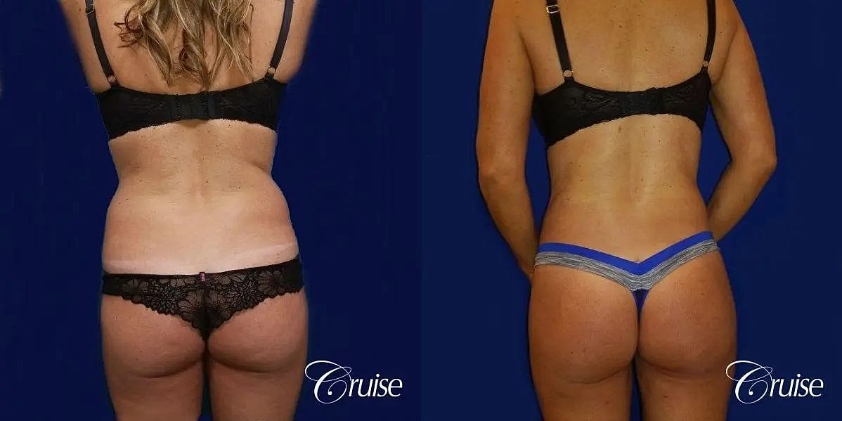 Liposuction Before & After