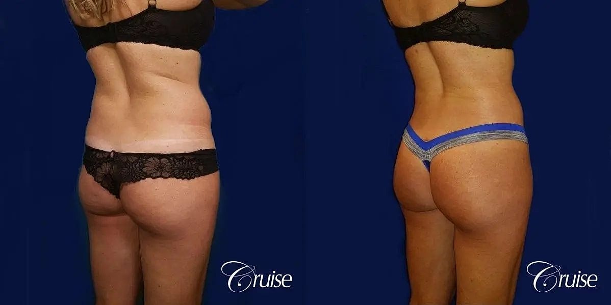 Liposuction Before & After
