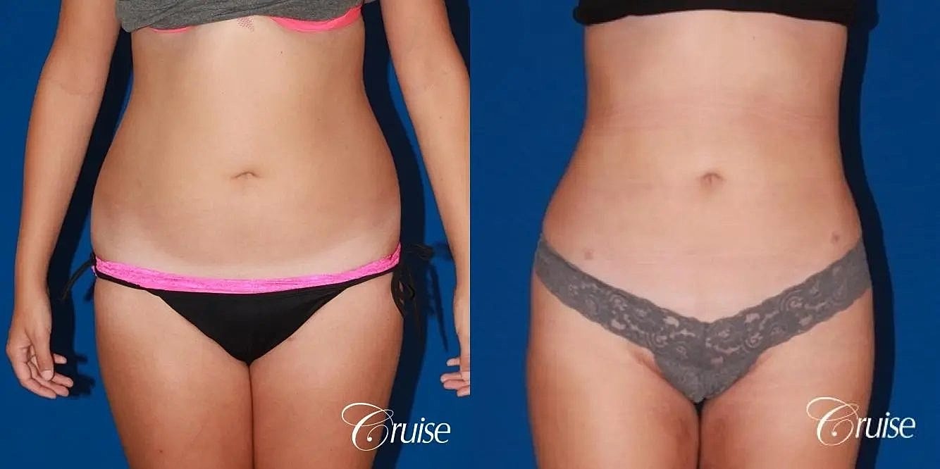 Liposuction Before & After