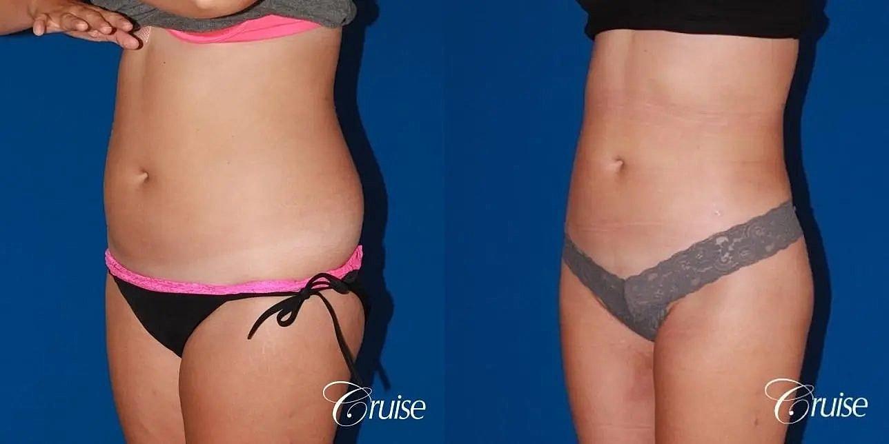 Liposuction Before & After
