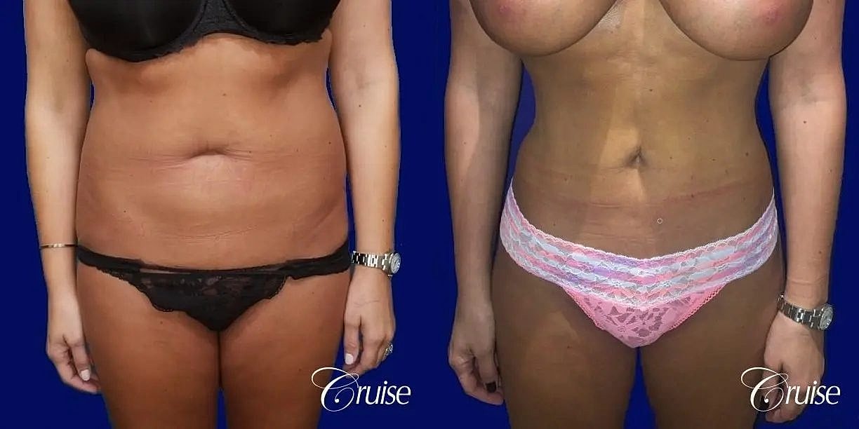 Liposuction Before & After