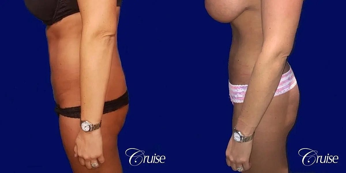 Liposuction Before & After