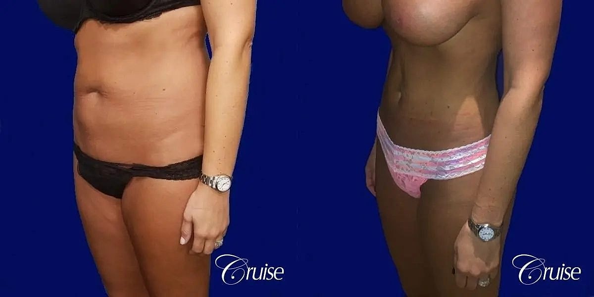 Liposuction Before & After