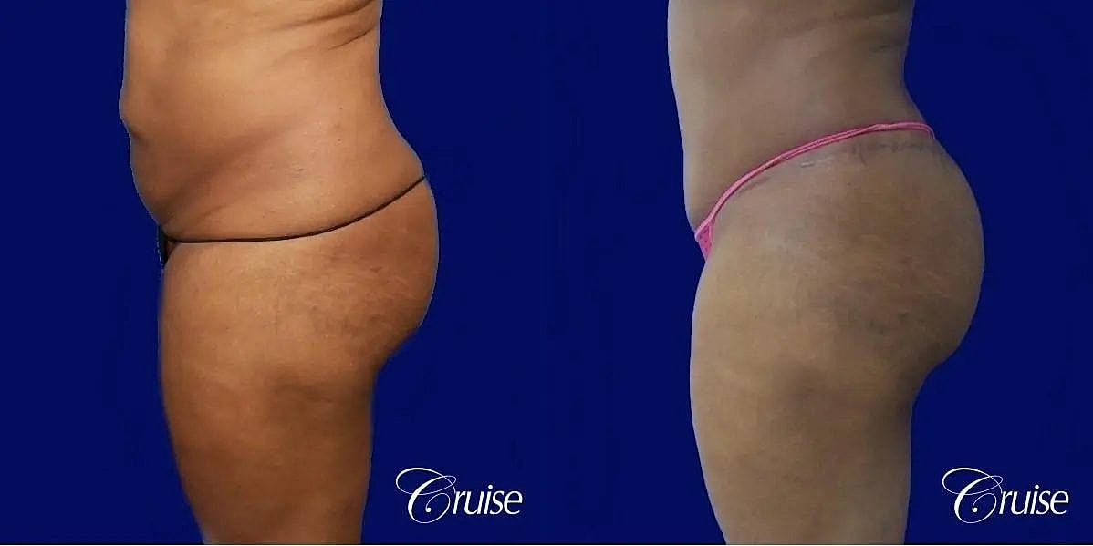 Liposuction Before & After