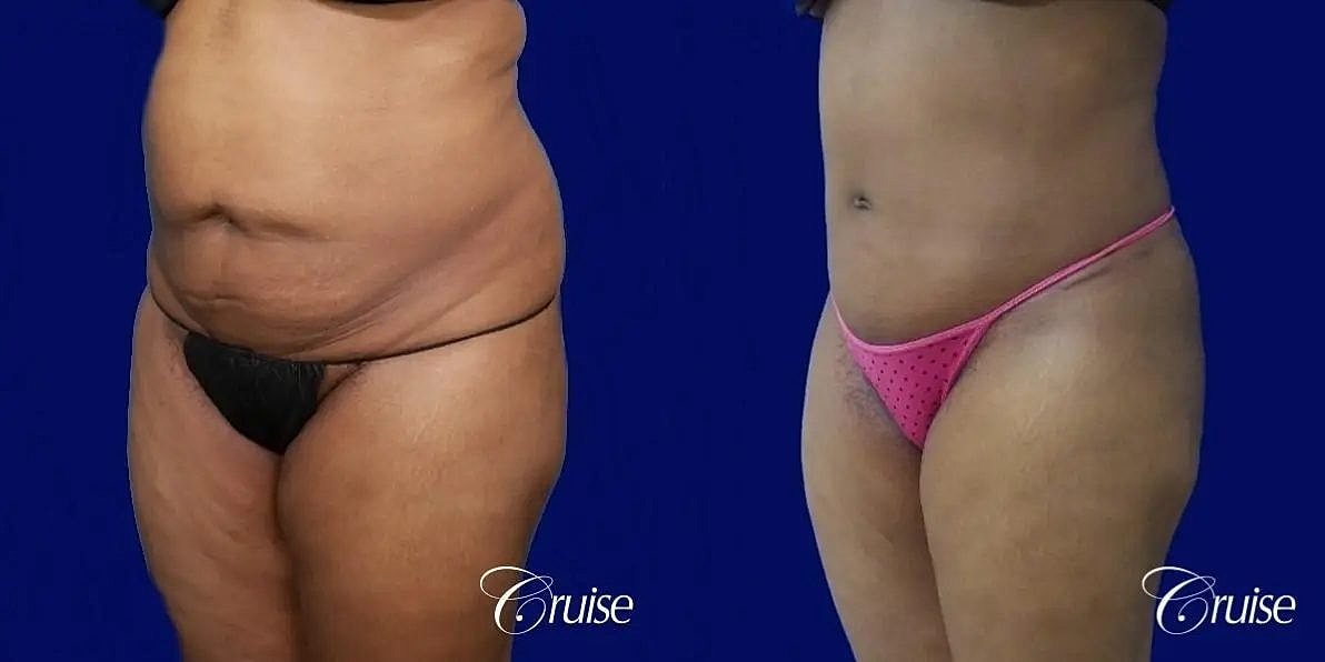Liposuction Before & After