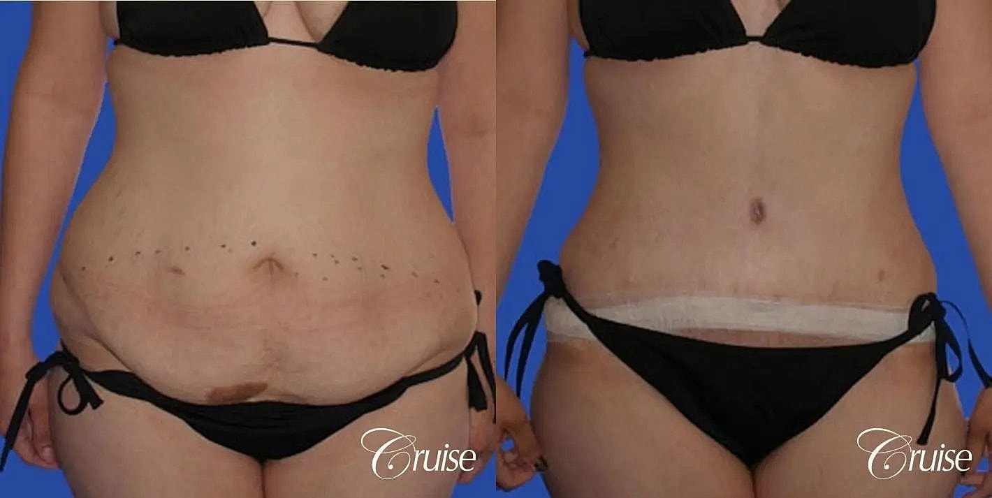 Liposuction Before & After