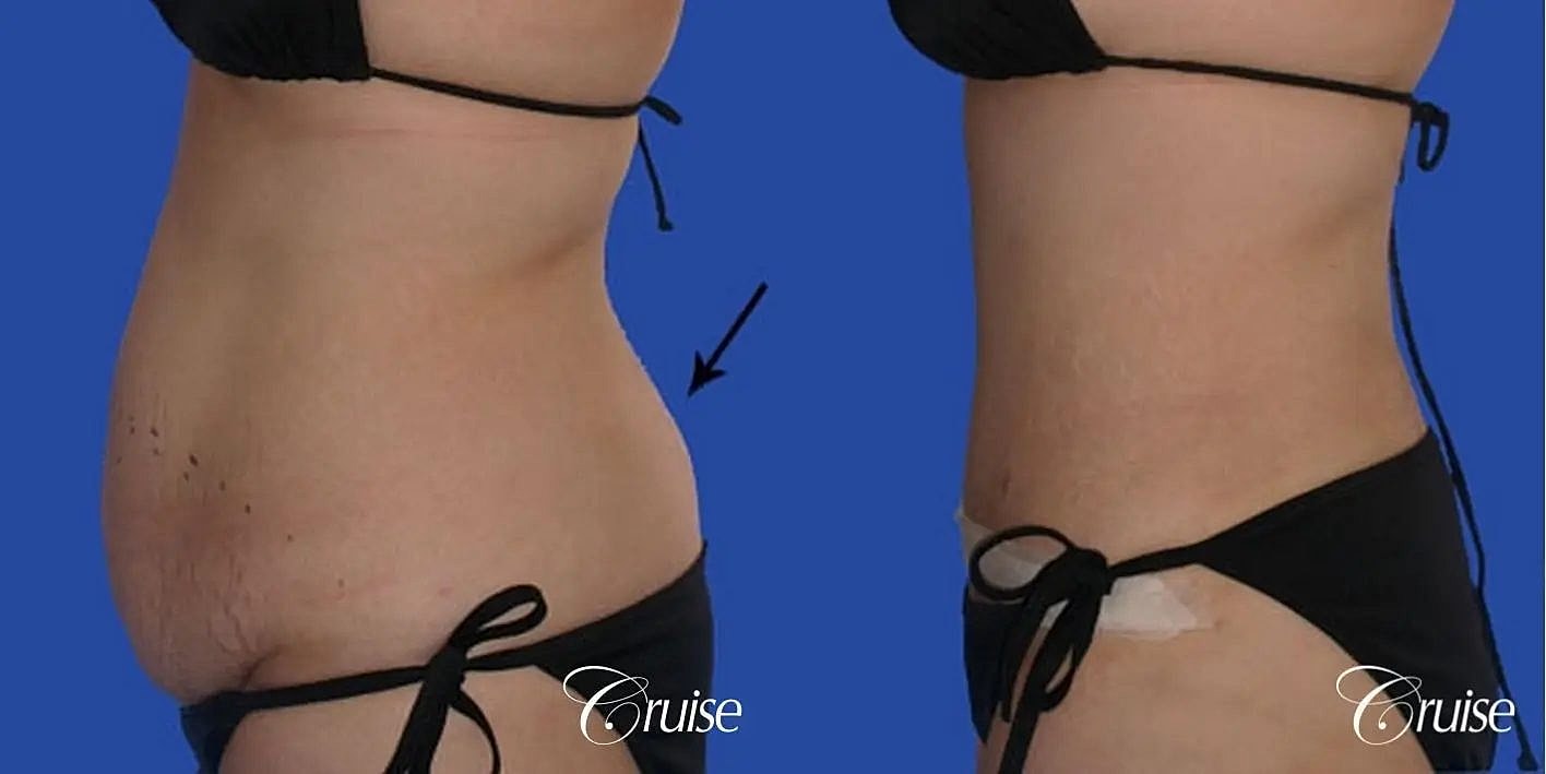 Liposuction Before & After