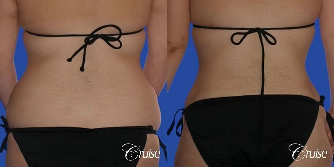 Liposuction Before & After