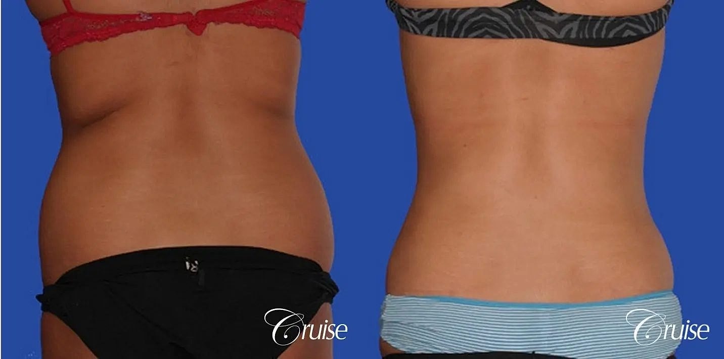 Liposuction Before & After